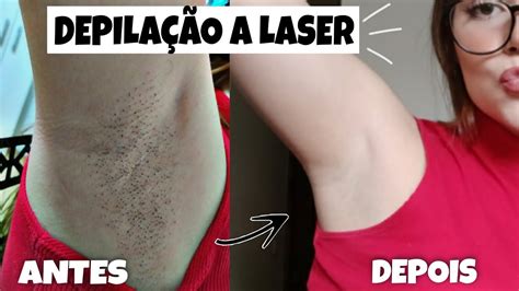 Depila O A Laser Funciona Mesmo Minha Experi Ncia Sess Es Depois