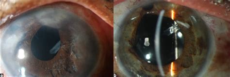 A And B Slit Lamp Photograph Of A Patient With Chronic Uveitis And