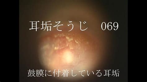 耳垢そうじ耳が痒い鼓膜に付着した耳垢069 Youtube