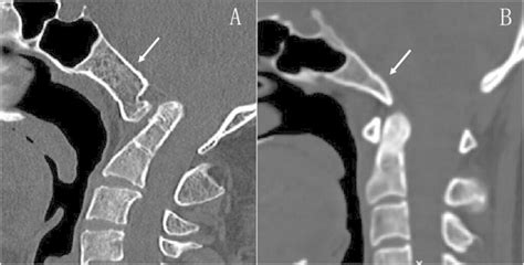 Clivus On X Ray