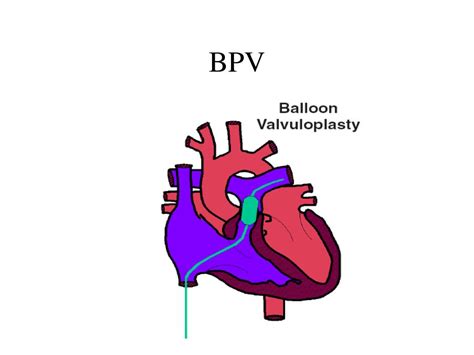 PPT - Balloon Mitral Valvuloplasty PowerPoint Presentation, free download - ID:687186