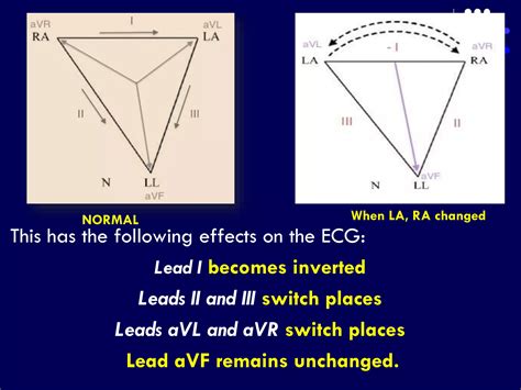 Ecg Limb Lead Reversal Ppt