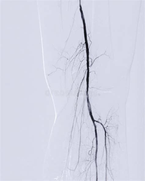 Femoral Artery Angiogram Or Angiography Stock Photo Image Of Media