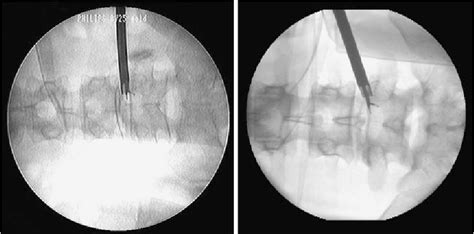 Percutaneous Endoscopic Lumbar Discectomy For Migrated Disc Herniation