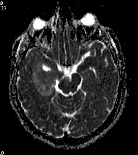 Radiodiagnosis Imaging Is Amazing Interesting Cases Epidermoid