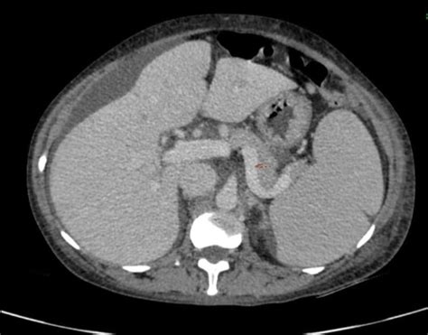 Dilated splenic vein-9.7 mm along with splenomegaly. | Download ...