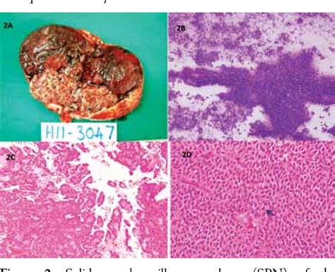 Figure 1 From Solid Pseudopapillary Neoplasm Of The Pancreas A Case Report With Review Of The