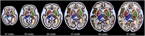 A Normative Spatiotemporal Mri Atlas Of The Fetal Brain For Automatic