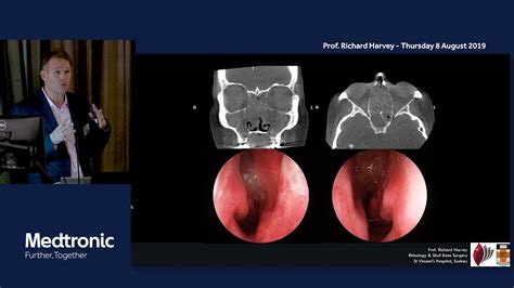 Understanding Inflammatory Sinus Disease Nasal Polyps And Chronic