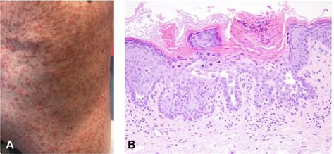 Grovers Disease On Day 153 Post Hsct A Diffuse Erythematous Scaling