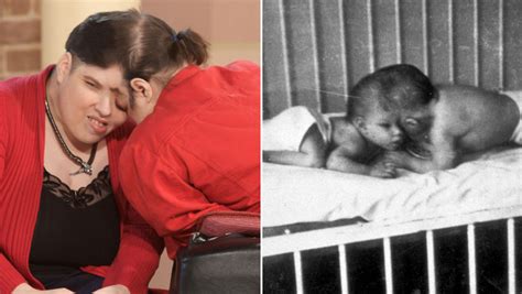 World S Oldest Conjoined Twins Lori George Schappell Dead At