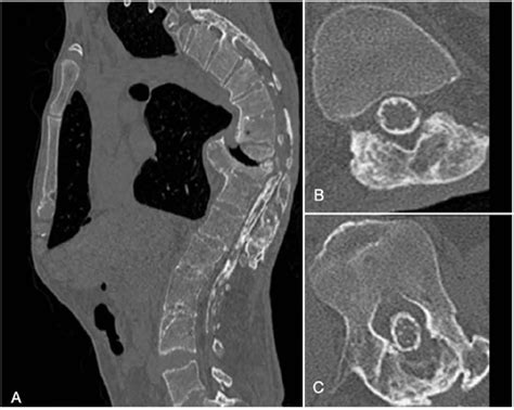 Scielo Brasil Arachnoiditis Ossifications In The Spine