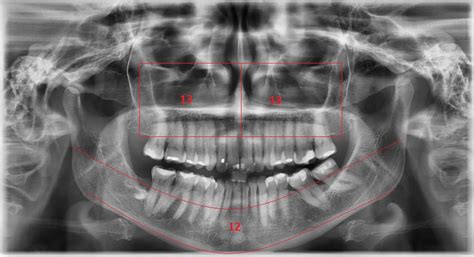 Radiografía panorámica qué es la ortopantomografía hr dental