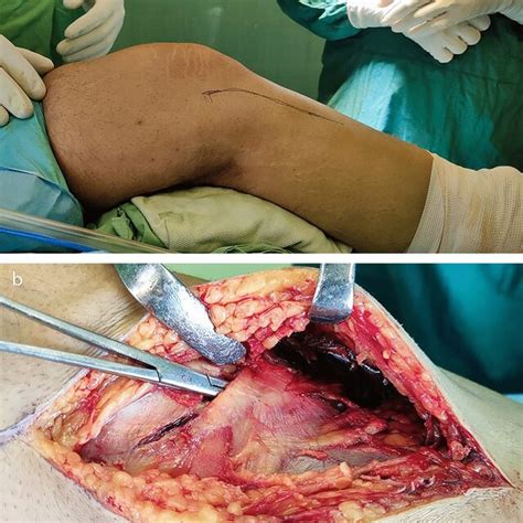 Intraoperative Photographs Showing A The Preoperative Incision Planning