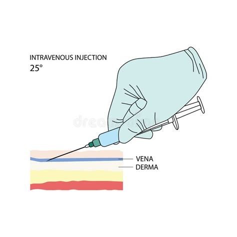 Intravenous Injection. Effective Methods of Administration of Drugs and Other Medical Solutions ...