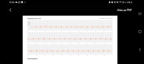 Delta waves? Please help.. : r/ReadMyECG