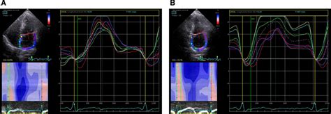 Left Atrial Strain Curves A Left Atrial Strain Curves In The Four