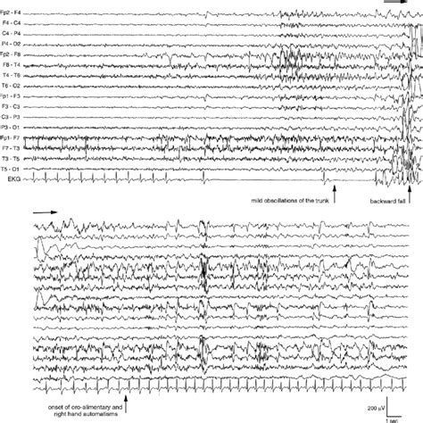 Figure At Seizure Onset Seizure Shown In Video 1 The Appearance In