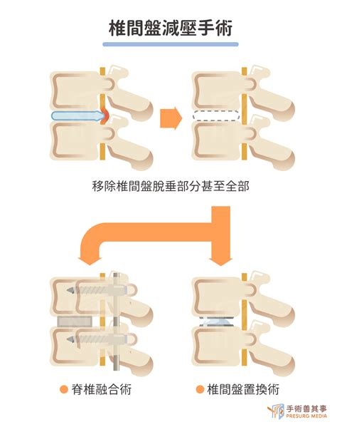 脊椎手術治療椎間盤突出、脊椎滑脫：手術原理、費用、後遺症