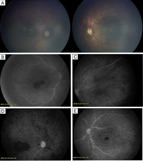 Adams Oliver Syndrome A Case Of Bilateral Progressive Ischemic