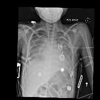 Object Detection Chest X Ray Object Detection Dataset And Pre Trained