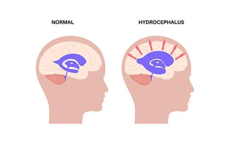What is normal pressure hydrocephalus: Billy Joel’s brain condition ...