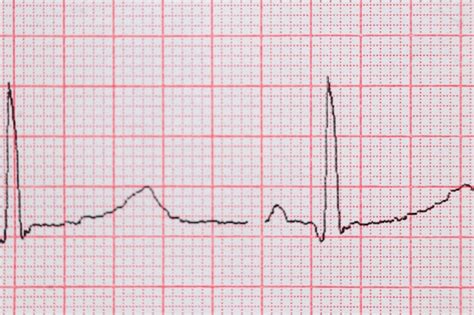 Cardiogram Waveform From An Ekg Showing Abnormal Ekg Test A Off