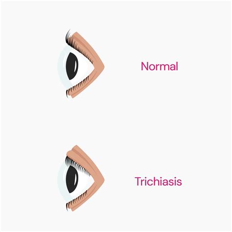 Double Eyelashes (Distichiasis) - Why Does It Happen?