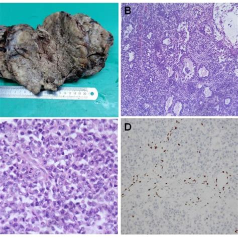 A Chromatograms Of SMARCA4 Exon 3 Sequence In Tumor And Normal Tissue