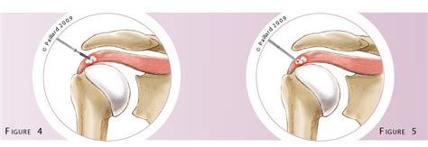 What Is An Arthroscopic Debridement Of Calcific Tendonitis