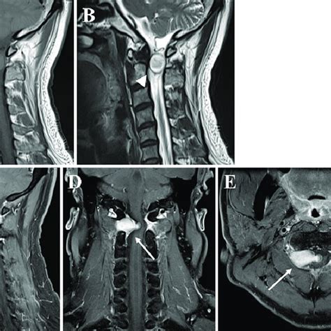 Preoperative Mri Sagittal T1 Weighted Magnetic Resonance Image A