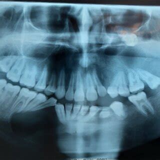 Panoramic Radiograph Shows Multiple Well Defined Multilocular