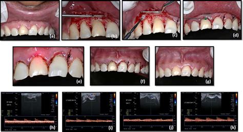 Split Mouth Flap Surgery A Pre Operative View B Mucoperiosteal Flap