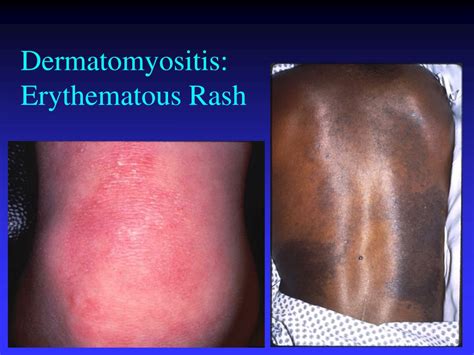 Dermatomyositis Rash On Legs