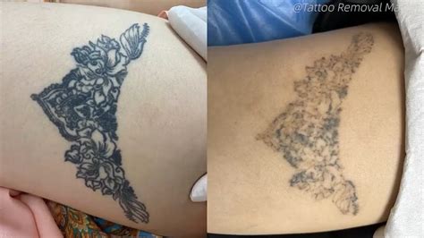 Removing Tattoos From A Womans Thighs With Two Types Of Lasers Youtube