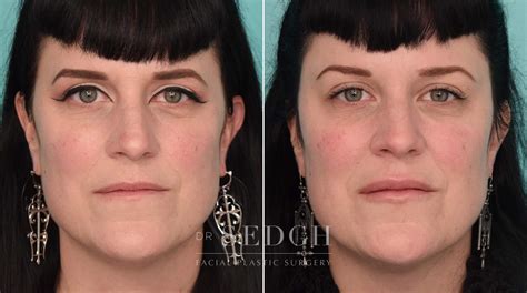 Temple Filler Before And After Photos Dr Jacob Sedgh