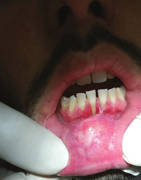 Salivary Glands In Lips Swelling Lipstutorial Org