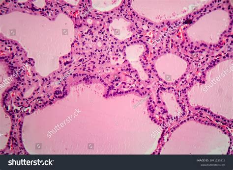 Endemic Goiter Light Micrograph Abnormal Enlargement Stock Photo