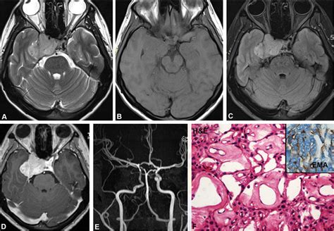 Meningioma T Wi T Wi Flair Postcontrast And Mra Showing Right