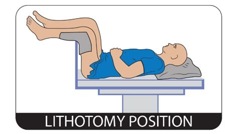 hemorrhoidectomy