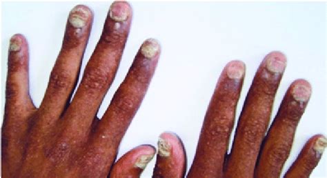 Tinea Unguium Endonyx Type Of All The Nails In A Hiv Positive 22years