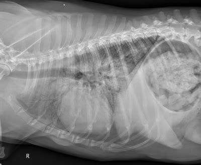 Lung X Ray With Pneumonia