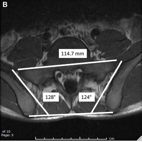 A Pelvic Model Demonstrating Axial Magnetic Resonance Mr