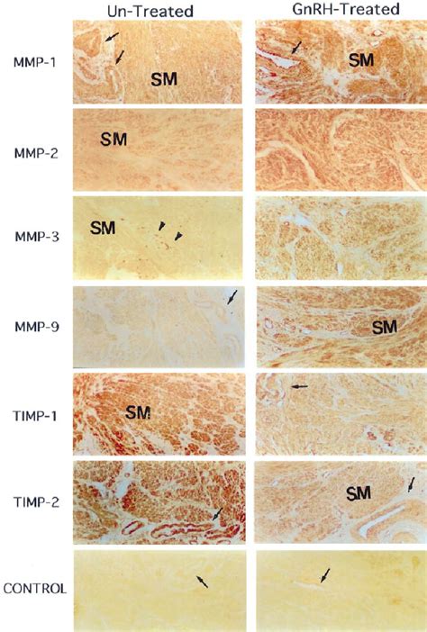 Immunohistochemical Localization Of MMP 1 2 3 9 And TIMP 1 And 2