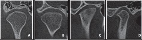 Scielo Brasil Tmj Response To Mandibular Advancement Surgery An