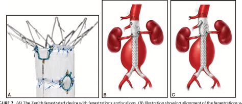 Pdf Experience With Fenestrated Endovascular Repair Of Juxtarenal Abdominal Aortic Aneurysms