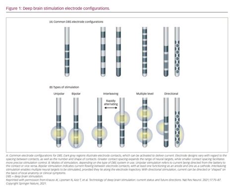 Directional Deep Brain Stimulation In The Treatment Of Parkinsons