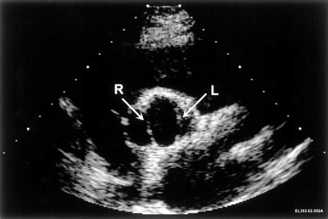 Bicuspid Aortic Valve Echo