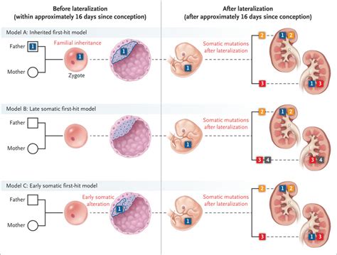 Bilateral Tumors — Inherited Or Acquired Nejm