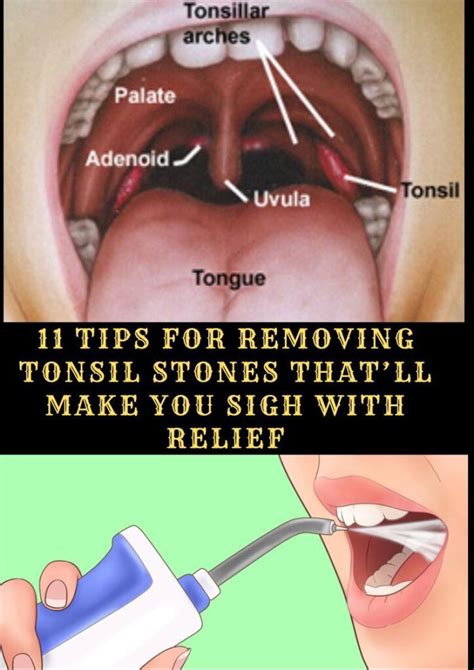 Tips On Removing Tonsil Stones With Relief Healthy